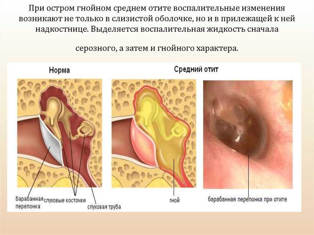 Отомикоз у детей - симптомы болезни, профилактика и лечение отомикоза у детей, причины заболевания и его диагностика на eurolab