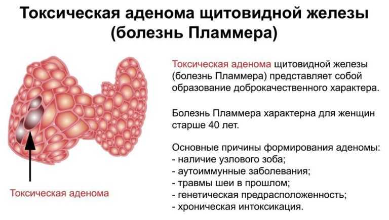 Зоб щитовидной железы: классификация, симптомы и лечение зоба щитовидки на шее у человека | клиники «евроонко»