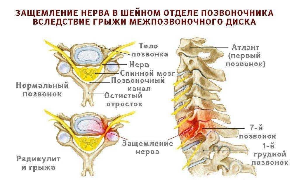 Схема лечения обострения остеохондроза