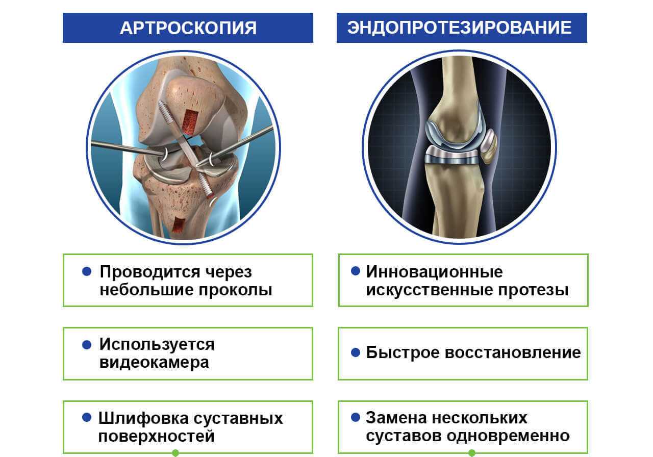 Поражение крупных суставов. Деформирующий артроз коленного сустава схема. Деформирующий остеоартроз коленного сустава. Остеоартроза коленного сустава. Степени артроза суставов.