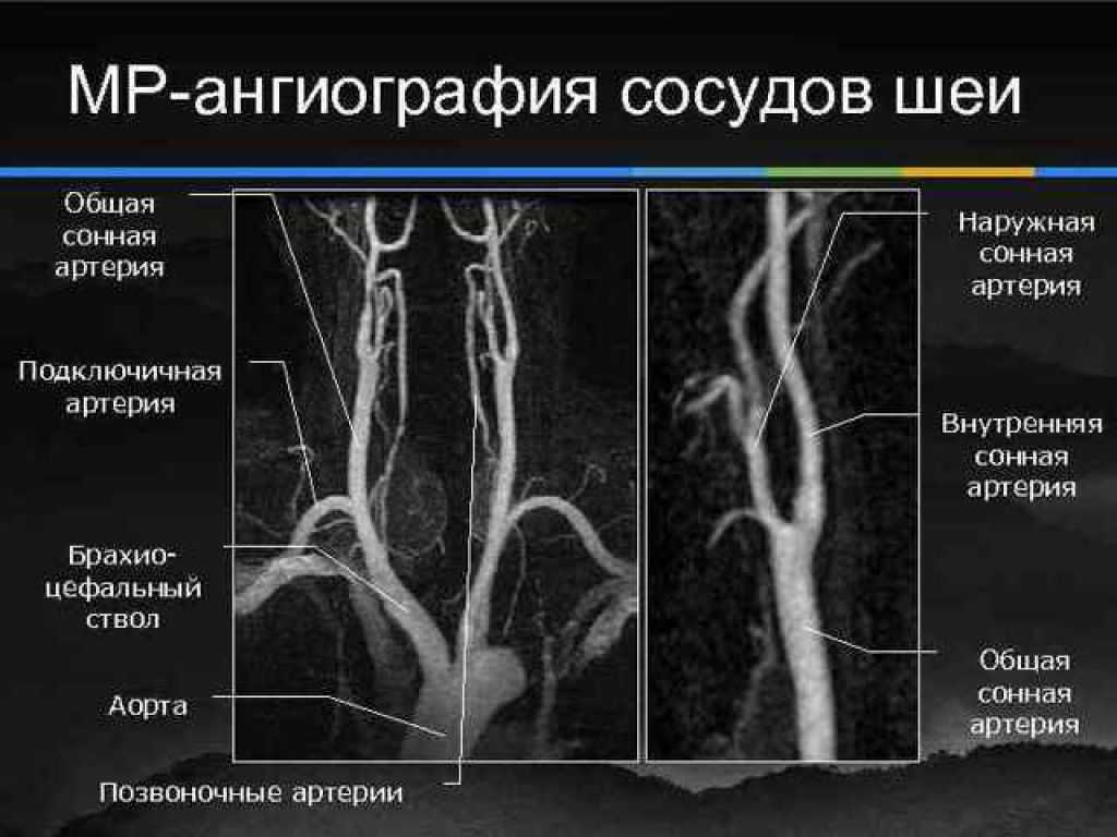 Стеноз подключичной. Кт-ангиография артерий шеи и головного мозга. Внутренняя Сонная артерия ангиография. Ангиография сосудов и артерий головного мозга. Кт ангиография сонных артерий.