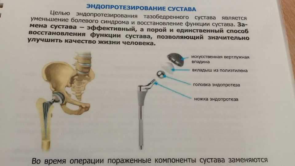 Артрит: причины, виды, симптомы | статьи мц «диагностика