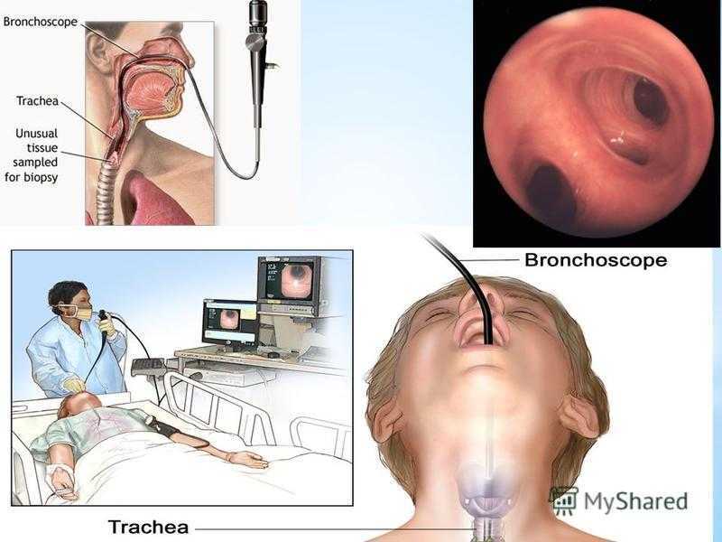 Как делают биопсию легких. Бронхоскопия трахеобронхоскопия. Бронхоскопия и бронхография. Трансбронхиальная щипцовая биопсия.