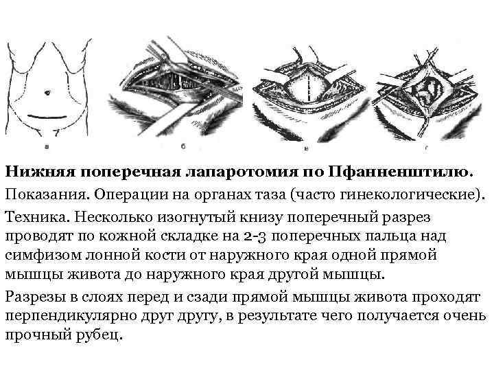 Лапороцентез. Разрез по Пфанненштилю операция. Пфаненштиль лапаротомия. Техника кесарева сечения с лапаротомией по Пфанненштилю.