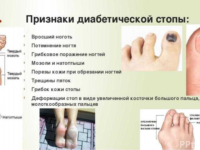 Причины трещин на пятках у женщин + быстрая помощь: мази и народные средства от глубоких трещин - glamusha
