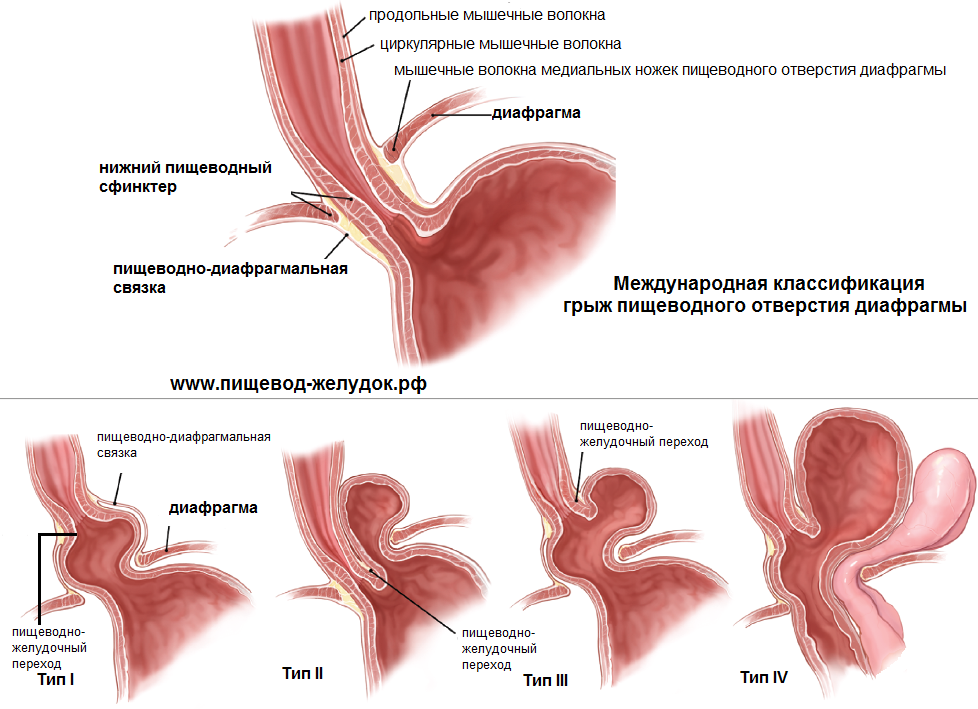 Схема лечения грыжи пищеводного отверстия диафрагмы