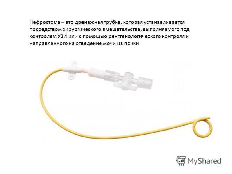 Уретероцеле — причины и симптомы. виды и лечение в цэлт