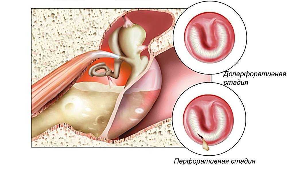 Средний отит картинка