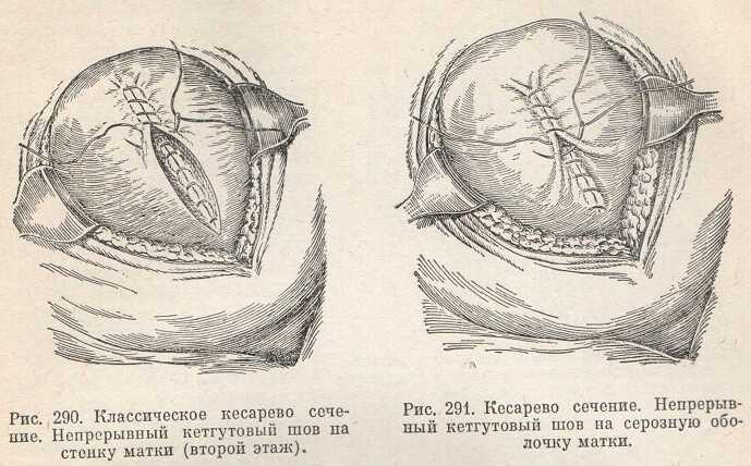 Сама откуда родом. Техника операции кесарева сечения. Кесарево сечение ушивание матки. Корпоральное кесарево сечение. Экстраперитонеальное кесарево сечение.
