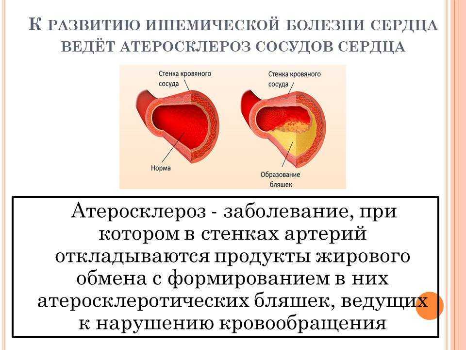Инфаркт симптомы и последствия. Симптоматика острого инфаркта. Признаки болевой формы инфаркта миокарда. Причины развития острого инфаркта миокарда.