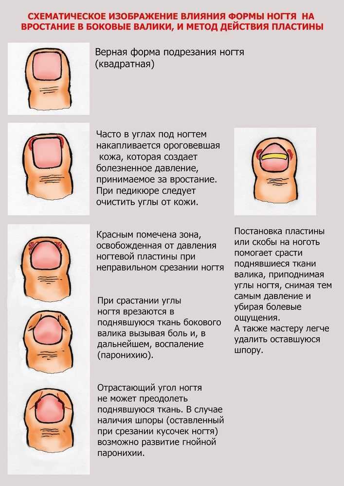 Вросший ноготь (онихокриптоз) – клиника «семейный доктор».
