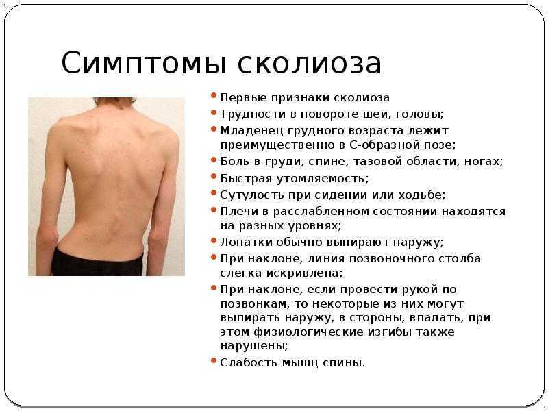 Сколиоз