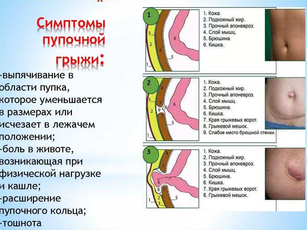 Лечение пупочной грыжи у взрослых