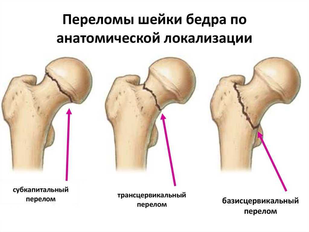 Перелом шейки бедра почему люди умирают. Классификация Pauwels переломы шейки бедра. Вколоченный перелом шейки бедренной кости. Переломы шейки бедра классификация рентген. Субкапитальный перелом шейки бедренной кости.