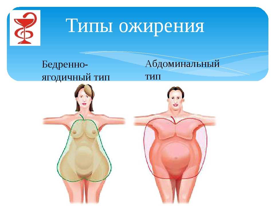 Сколько откладывается жир. Бедренно ягодичный Тип ожирения. Ожирение по абдоминальному типу. Абдоминальный Тип ожирения у женщин. Типы отложения жира.