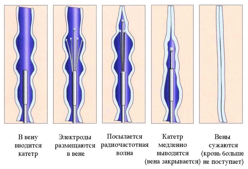Куда течёт кровь после удаления вен
