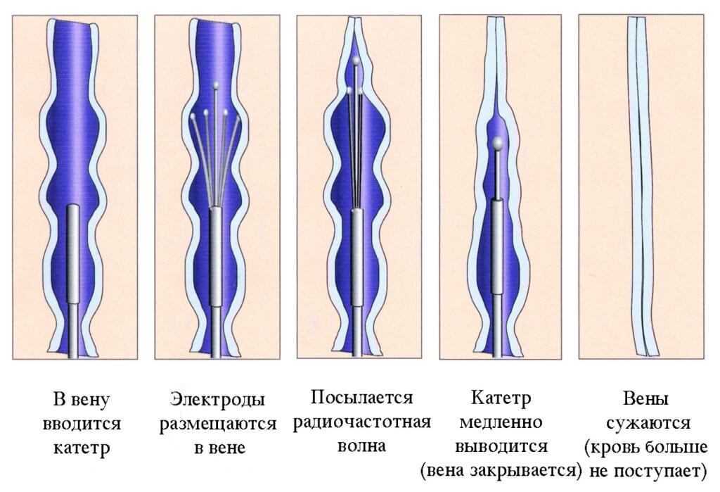 Куда течёт кровь после удаления вен