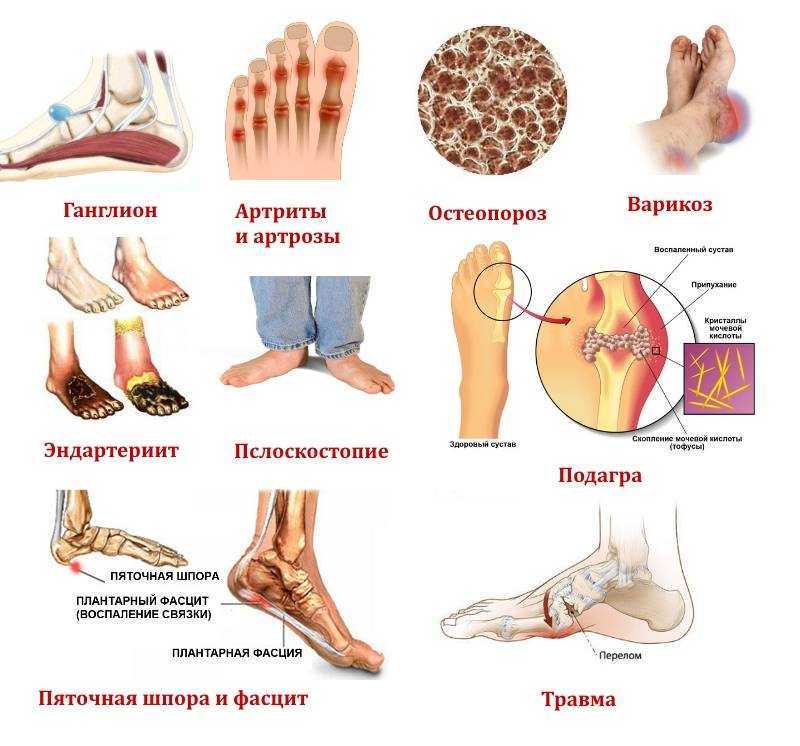 От чего возникают трещины на пятках и как их лечить в домашних условиях