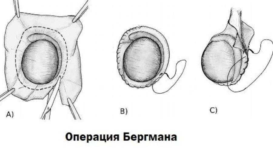 Уплотнение на яичке у мужчин. Операция Винкельмана Бергмана. Гидроцеле яичка операция Винкельмана. Операции Винкельмана и Бергмана при водянке яичка. Операция Бергмана гидроцеле.