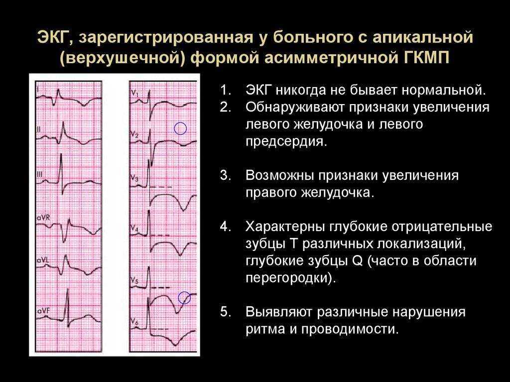 Изменения миокарда левого желудочка сердца. ЭКГ при гипертрофической кардиомиопатии. Асимметричная гипертрофическая кардиомиопатия на ЭКГ. ЭКГ при гипертрофической КМП. Признаки изменения миокарда на ЭКГ.