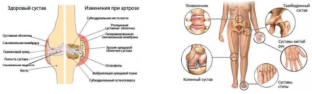 Артроз коленного сустава: причины, симптомы и лечение – эл клиника