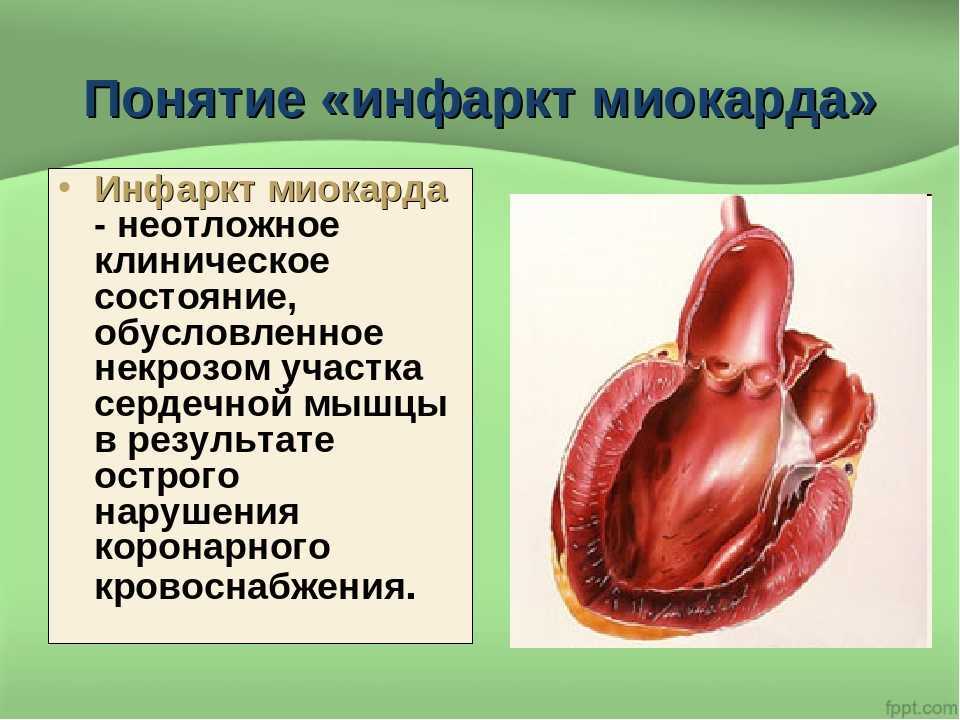 Инфаркт симптомы и последствия. Инфаркт миокарда понятие. Презентация на тему инфаркт. Доклад на тему инфаркт.