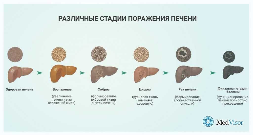 Мешки под глазами