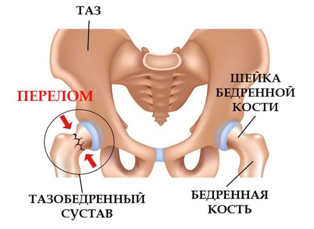 Перелом бедра рисунок