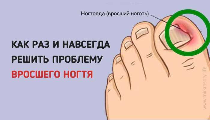 Вросший ноготь (онихокриптоз)