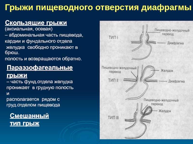 Грыжи пищеводного отверстия диафрагмы презентация по хирургии