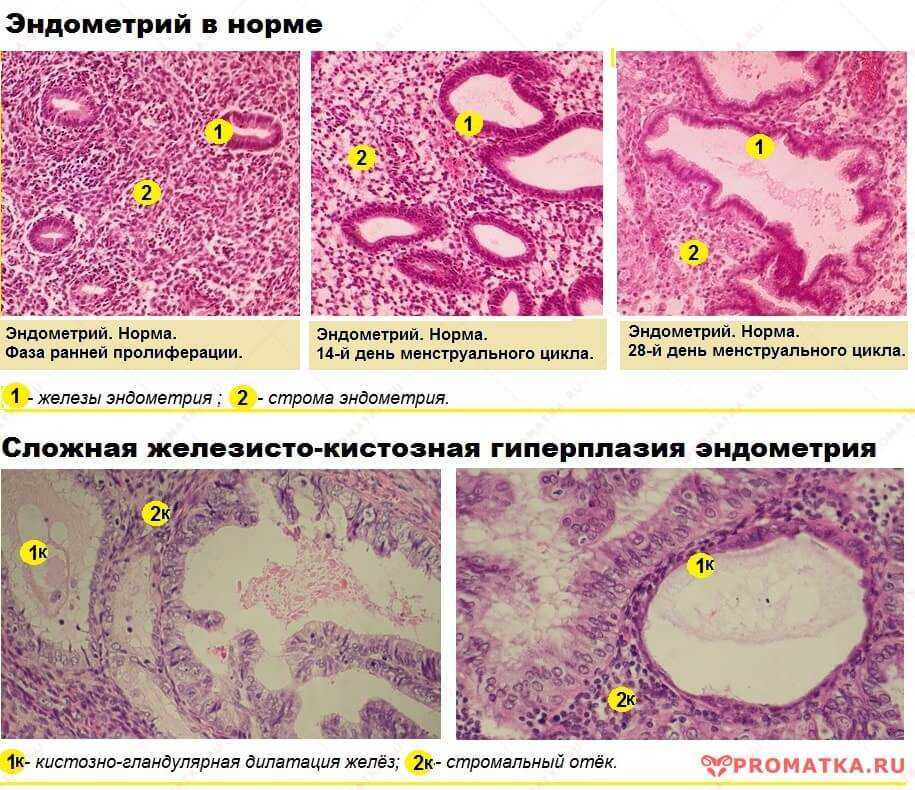Гиперплазия эндометрия картинки