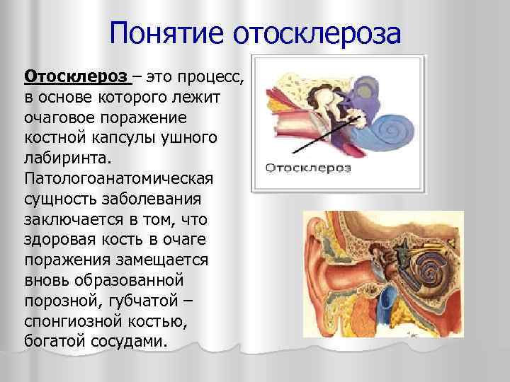 Отосклероз — диагностика и лечение в цэлт