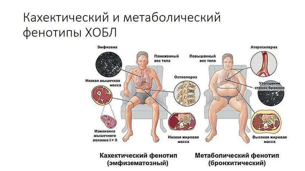 Эмфизема легких: лечение, симптомы, причины, признаки