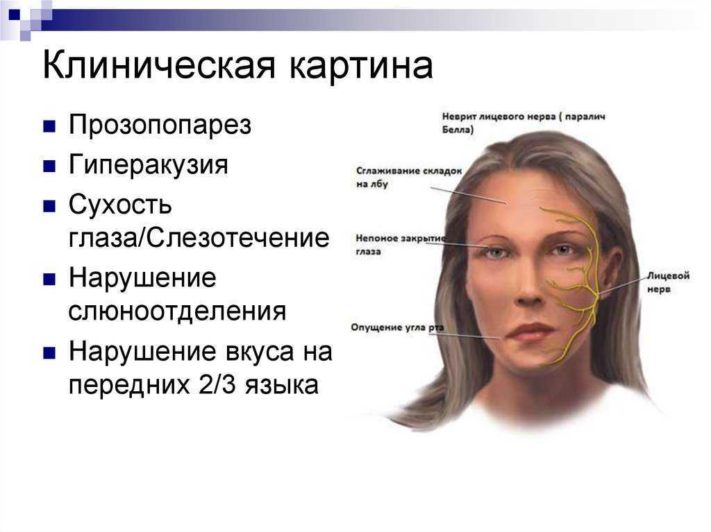 Невропатия лицевого нерва