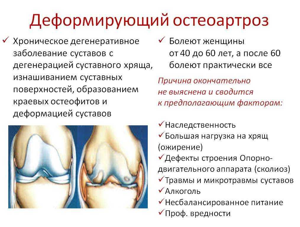 Остеоартрит. симптомы, диагностика и лечение артрита.!