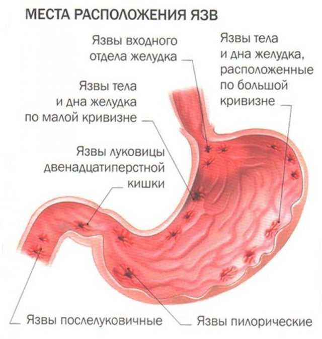 Язва двенадцатиперстной кишки