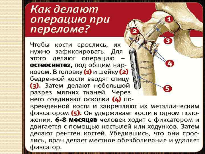 Переломы. первая помощь при переломе. лечение переломов. аппарат илизарова