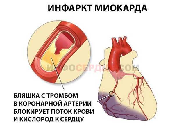 Инфаркт симптомы и последствия. Инфаркт миокарда сердце. Сердце после микроинфаркта. Инфаркт миокарда микро.