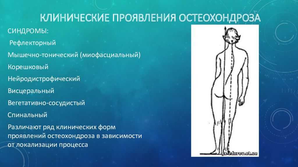 Рефлекторные боли. Рефлекторные синдромы при поясничном остеохондрозе. Рефлекторные мышечно тонические синдромы шейного остеохондроза. Рефлекторный мышечно-тонический синдром. Остеохондроз позвоночника мышечно-тонический синдром.