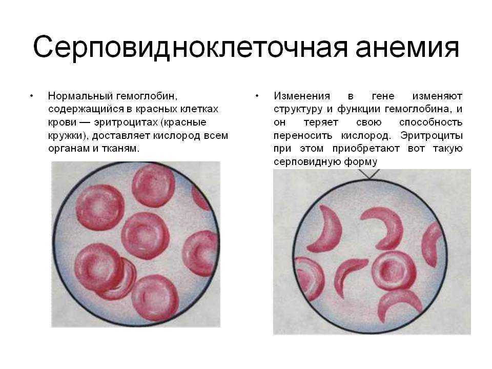 Ген серповидноклеточной анемии. Форма эритроцитов при серповидноклеточной анемии. Серповидная анемия эритроциты. Структура гемоглобина при серповидноклеточной анемии. Сероповидно клеточная анемия.