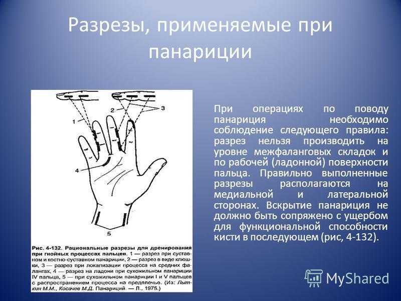 Панариций. причины, симптомы и лечение