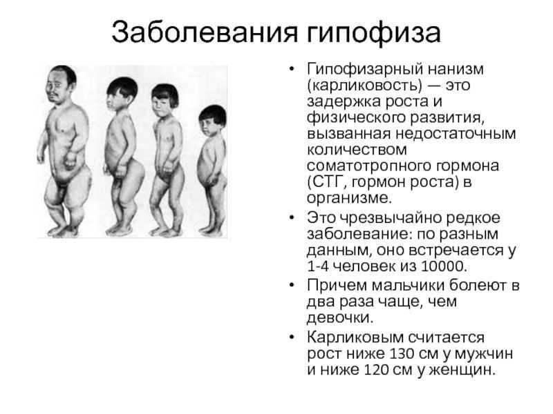 Гипофизарный нанизм (карликовость)