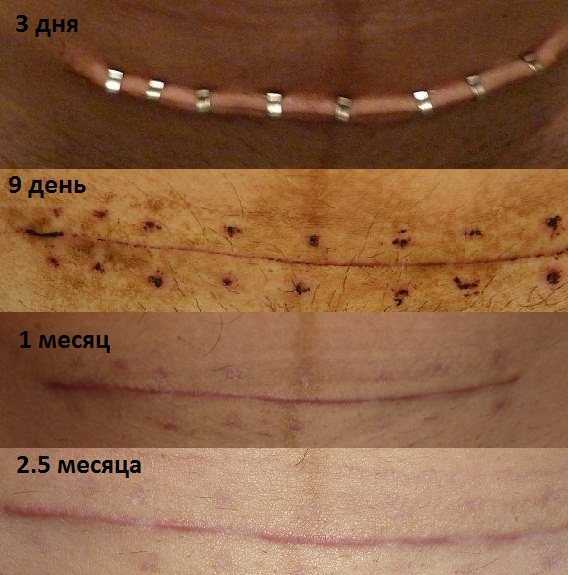 Дренирование послеоперационной раны: как проводится, уход за раной и рекомендации врача | услуги клиники «проксима» (г. сочи)