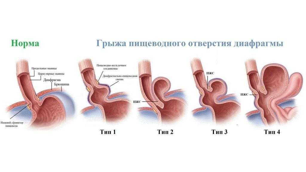 Эндоскопическая картина при грыжах пищеводного отверстия диафрагмы характеризуется