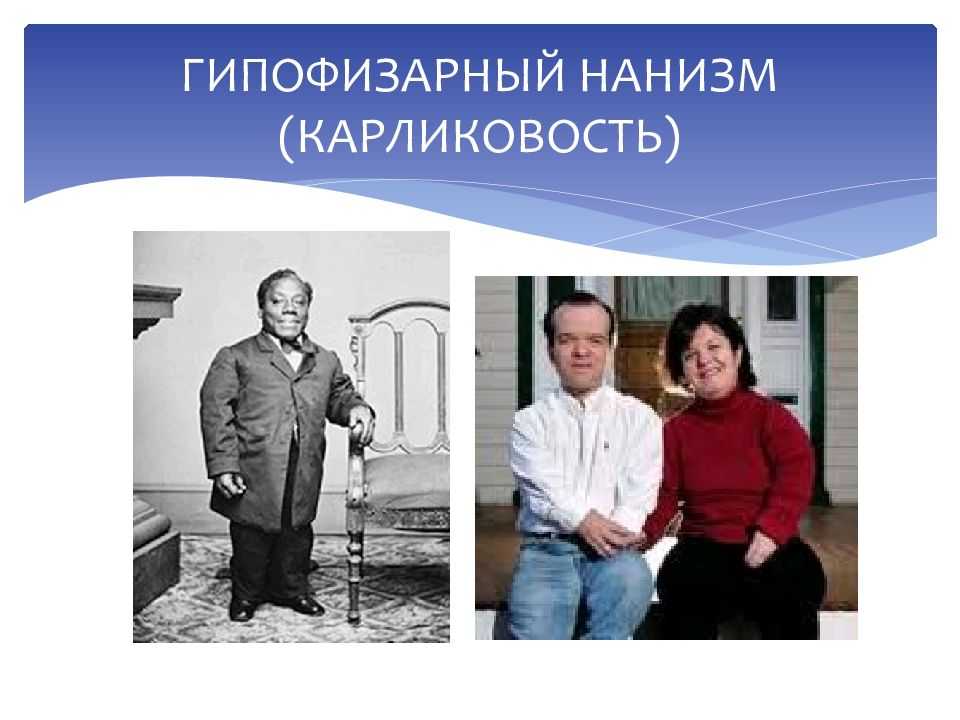 Карликовость щитовидной железы. Гипофизарный нанизм (карликовость). Гипофизарная карликовость (гипофизарный нанизм).