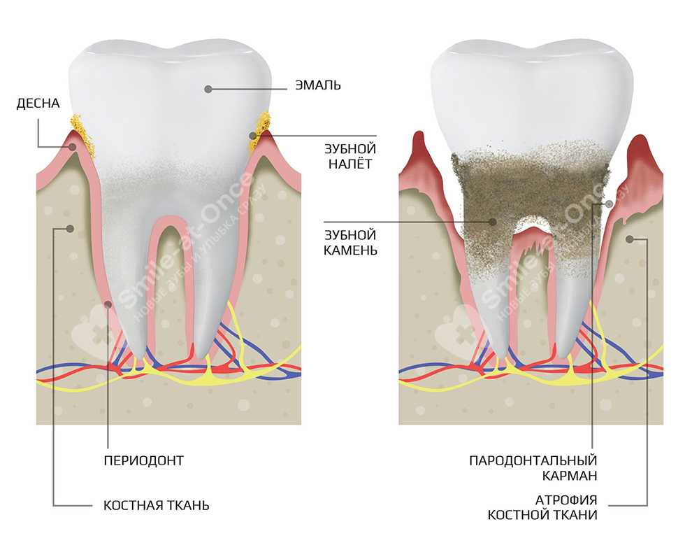 Воспаление десны вокруг зуба