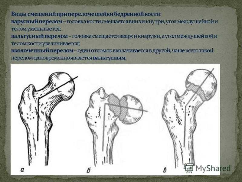 Перелом шейки бедра видео