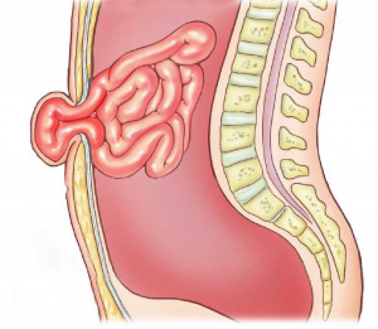 Пупочная грыжа рисунок схема