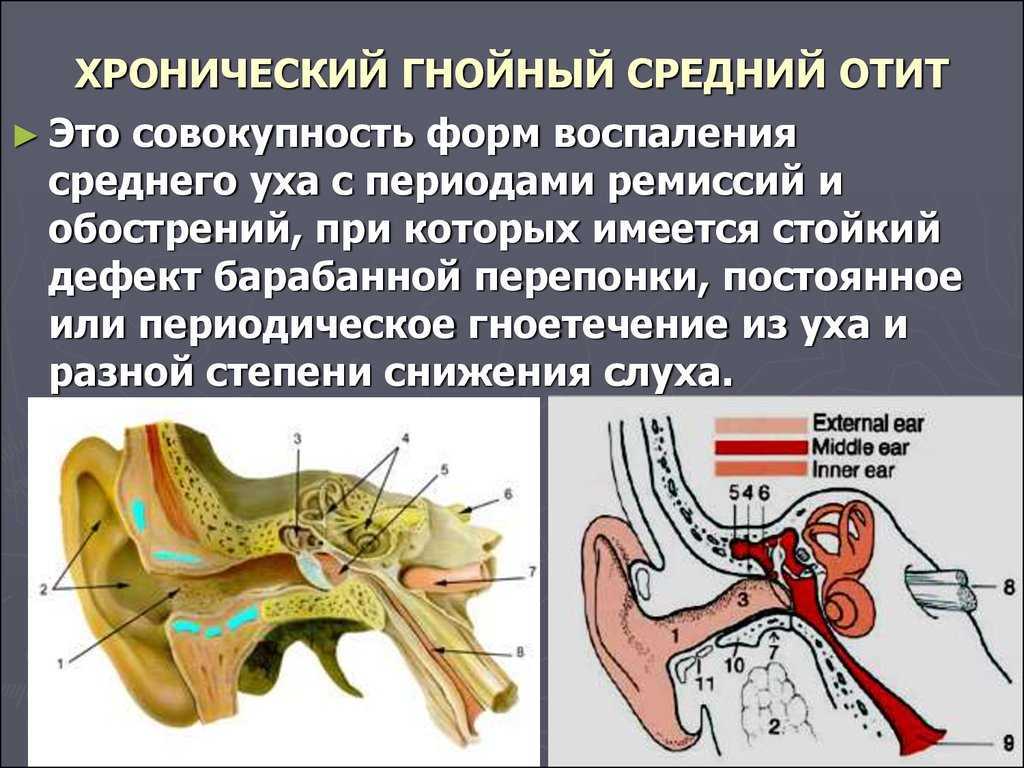 Барабанная перепонка при хроническом отите. Заболевание среднего уха средний отит. Хронический туботимпанальный Гнойный средний отит клиника. Хроническое воспаление среднего уха.