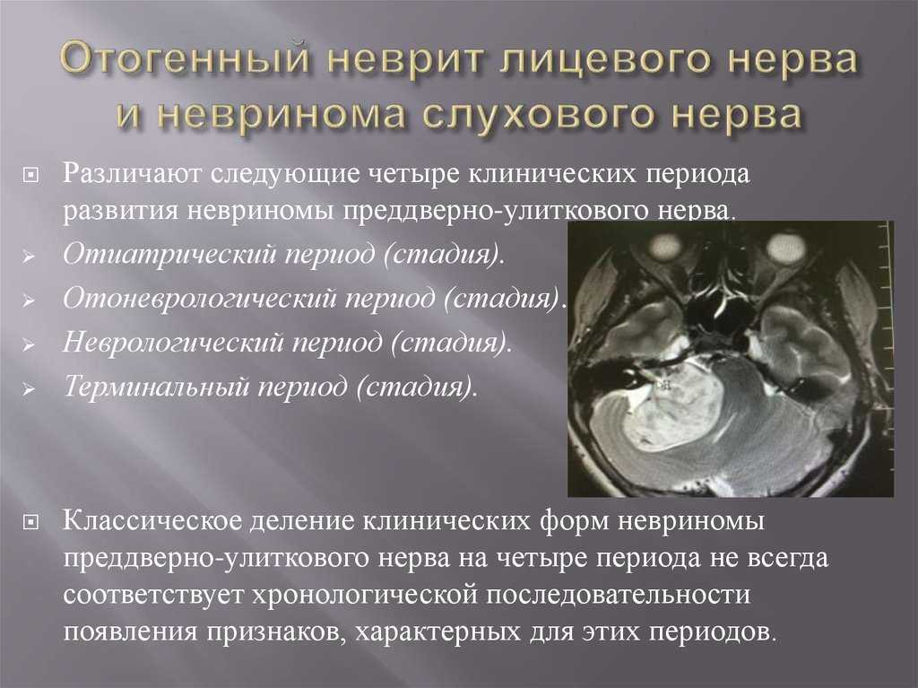 Неврит кохлеарный. причины, симптомы и лечение!